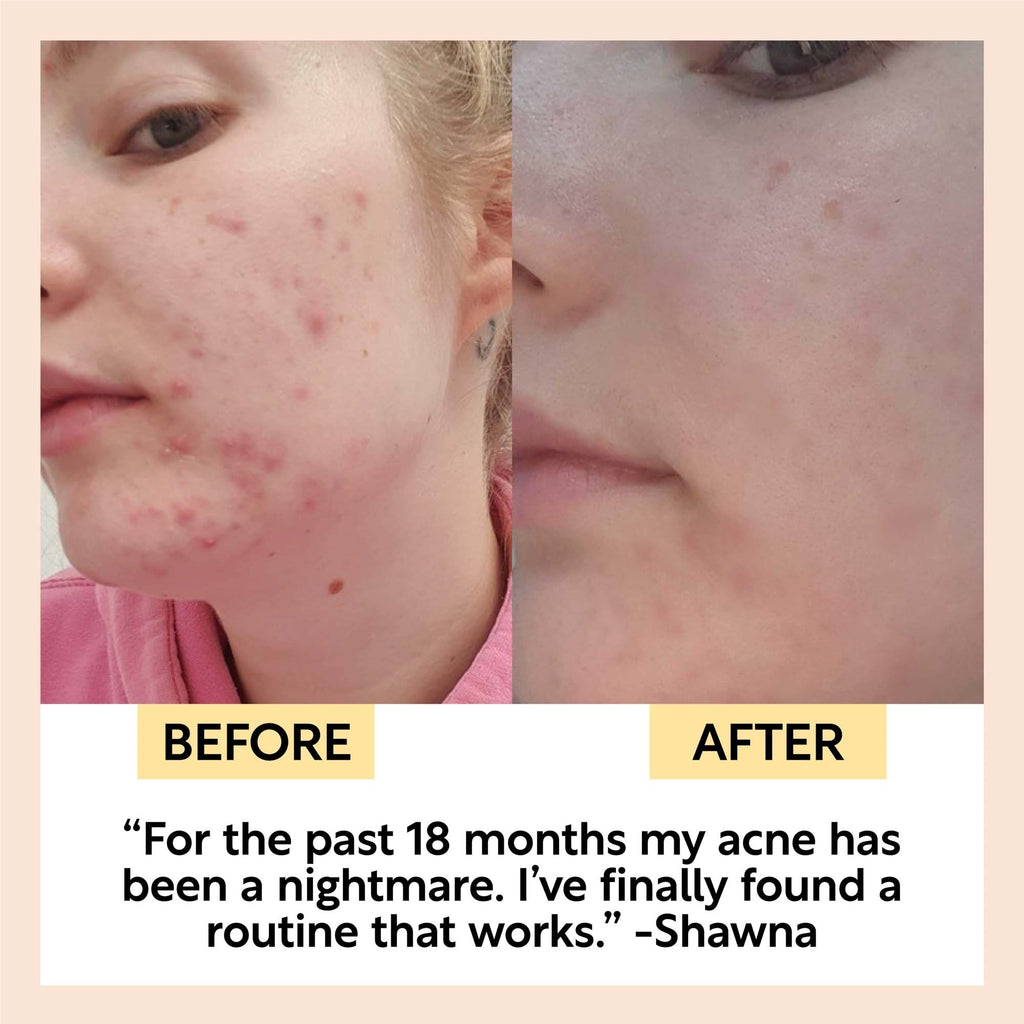 The Acne-Prone Bundle